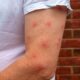 Bug Bite