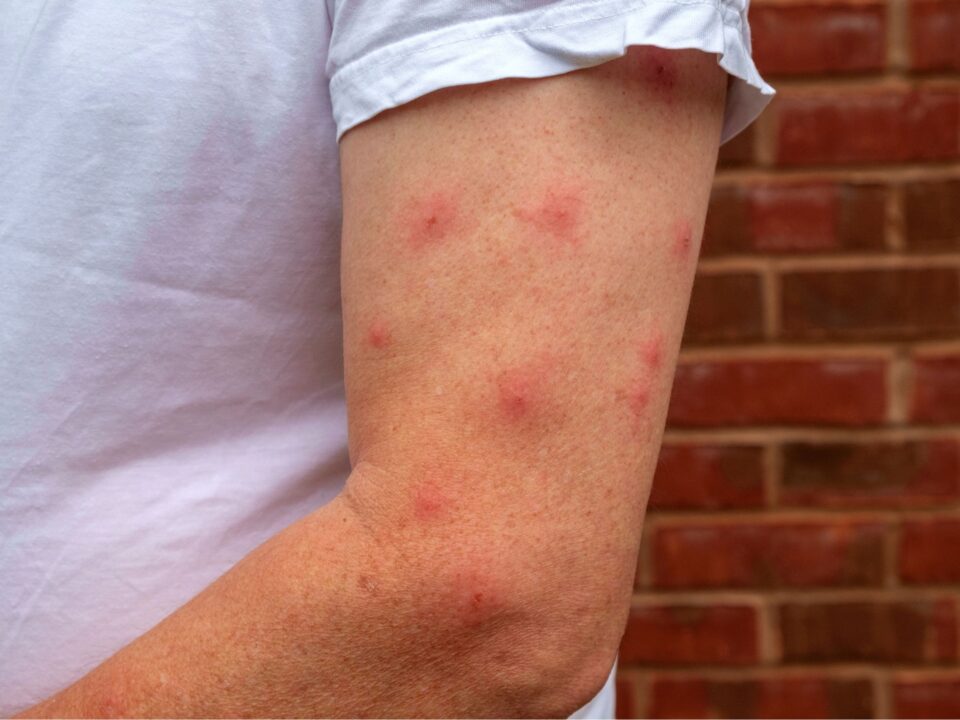 Bug Bite
